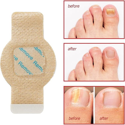 Nail Repair Patches,21 Pieces Extra Strong 8-Hour Repair Pads for Toenail Fungus, Ingrown Nail Relief Damaged Nail Recovery
